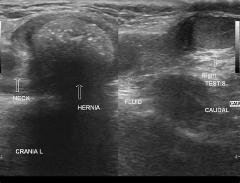 inguinal hernia radiopaedia